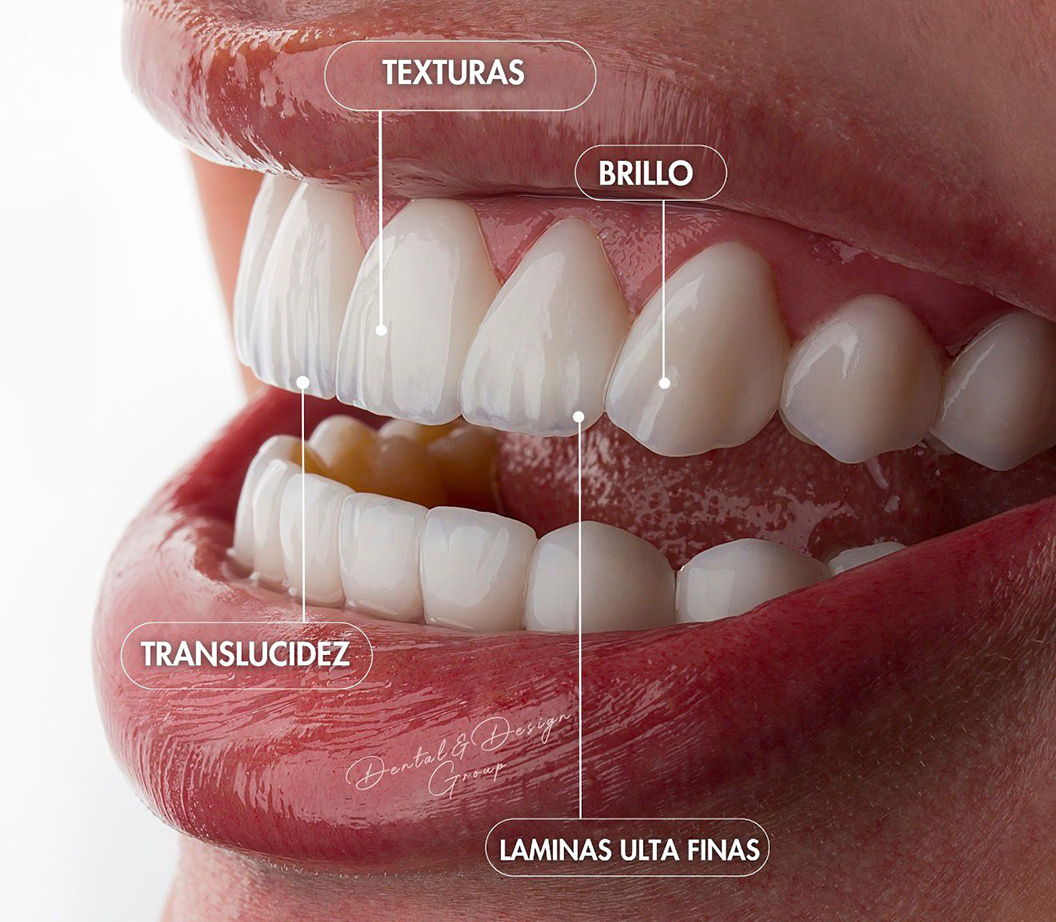 Primer plano carillas dentales con textura y translucidez