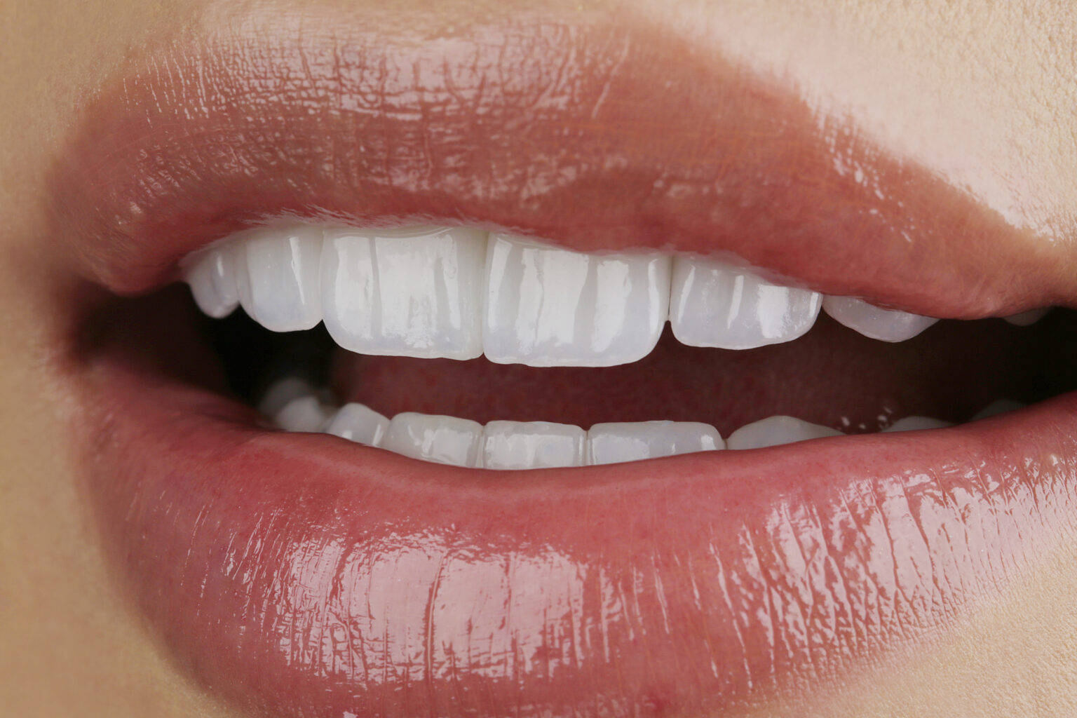 Primer plano de carillas de cerámica - Dental & Design