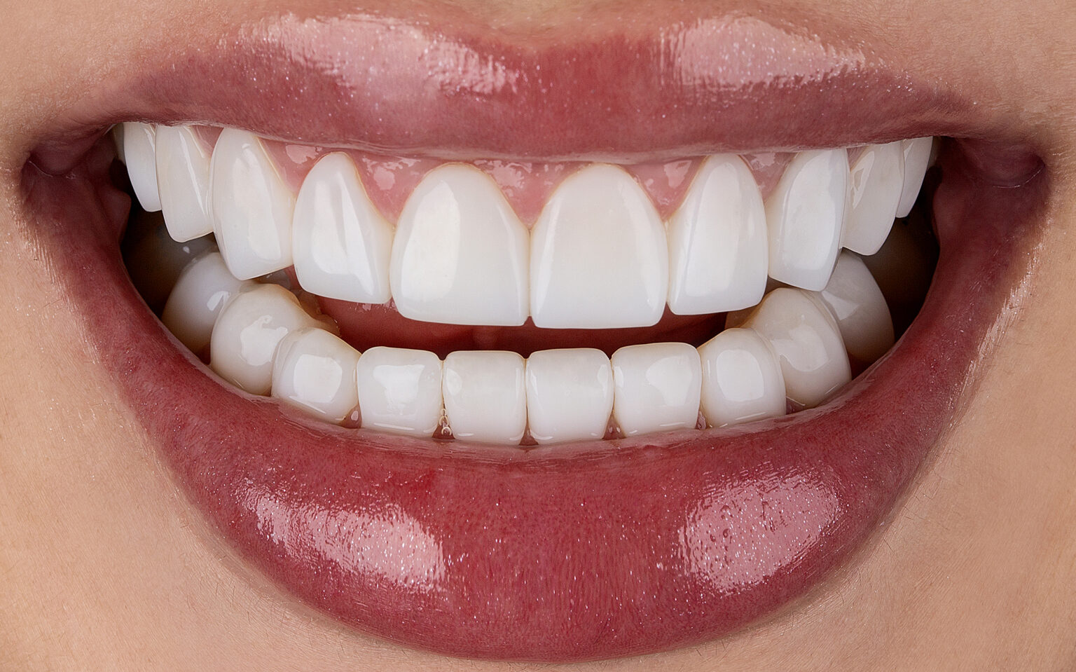 Primer plano de carillas en composite - Dental & Design
